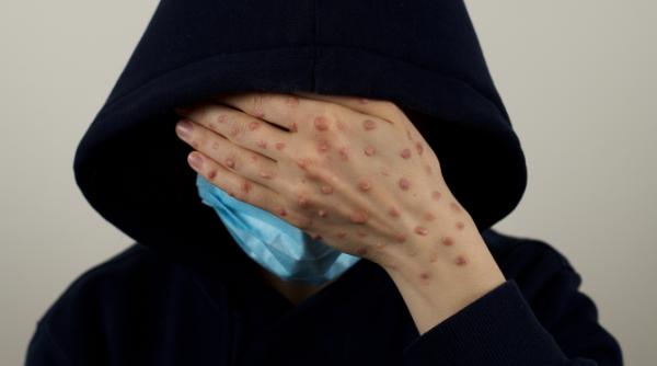 primul caz de mpox detectat in kosovo autoritatile iau masuri pentru prevenirea raspandirii