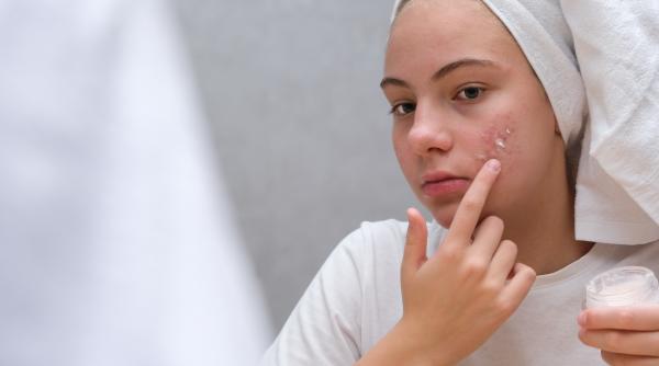 crema impotriva acneei retrasa de pe piata un lot intreg cu urme de substanta cancerigena