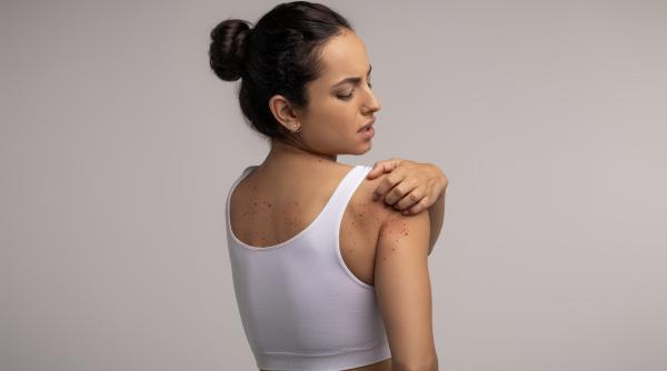 patru semne ale pielii care pot indica o boala hepatica potrivit unui medic gastroenterolog