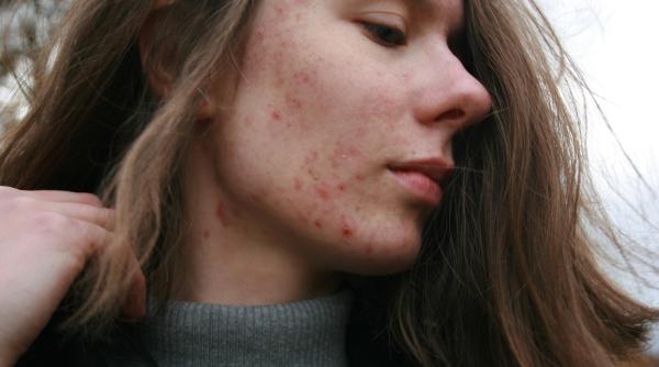 mituri spulberate acneea nu este hormonala si nici infectioasa dermatologul alin nicolescu demonteaza teoriile care circula online