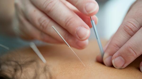 merita sa apelati la acupunctura pentru dureri un nou studiu ofera raspunsuri