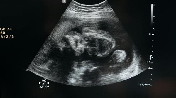 ce este un lithopedion sau bebelusul de piatra o raritate medicala care fascineaza lumea