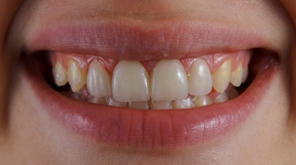 un dentist dezvaluie de ce dintii tai sunt galbeni chiar daca ii speli corect