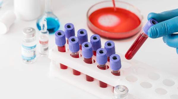 analiza care arata daca ai deficit de fier sideremie feritina si fier seric par la fel dar doar una iti spune adevarul