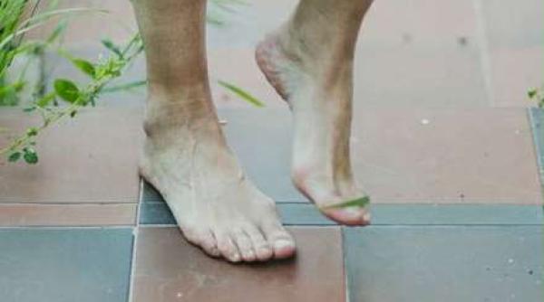 monturile genetice sau dobandite dr huszar cel mai mare factor de risc