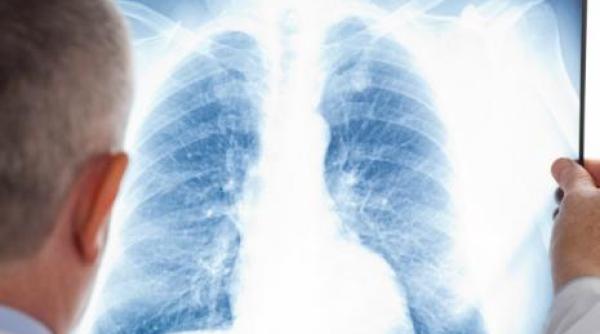 tuberculoza in topul mortalitatii infectioase la nivel mondial