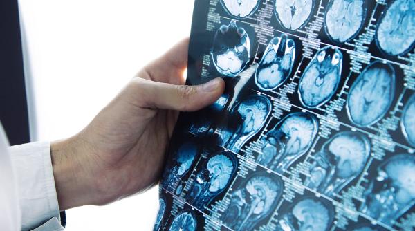 ce proceduri moderne de neuroradiologie interventionala se efectueaza pentru afectiuni cerebrale si spinale