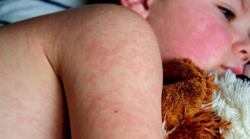 Rujeola, din nou o amenințare: vaccinarea scade, iar tratament nu există