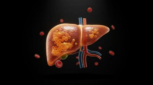 Un obicei aparent banal care îți poate afecta ficatul pe termen lung. Un singur suc acidulat pe zi crește riscul de cancer hepatic