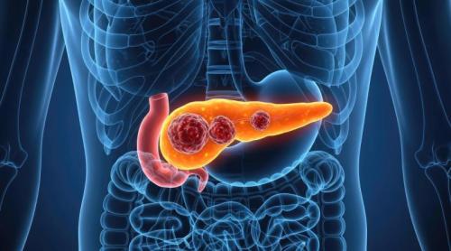 Punctul slab al cancerului pancreatic, identificat de medici