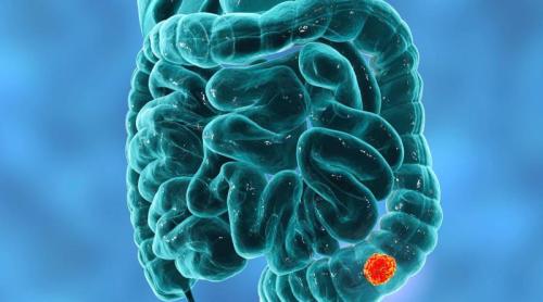 Semnele ascunse ale cancerului colorectal pe care tinerii le trec cu vederea