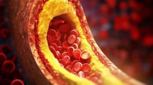 Semnele discrete ale colesterolului ridicat pe care mulți le trec cu vederea. Explicațiile unui cardiolog