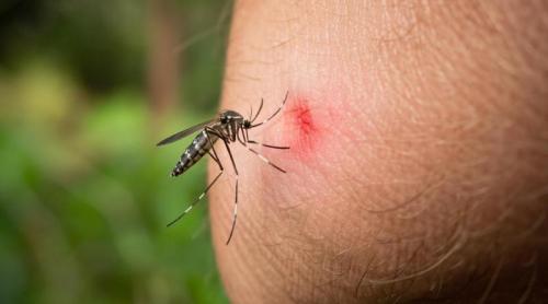 Trucul simplu recomandat de un dermatolog pentru înțepăturile de insecte