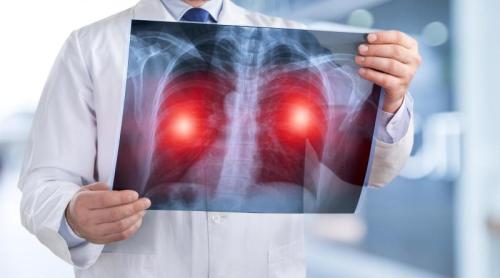 Cancerul care ucide cel mai mult în România. Testul simplu care poate salva vieți înainte să apară simptomele cancerului pulmonar