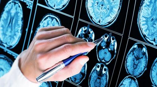 Ce au găsit cercetătorii în creierul persoanelor cu Alzheimer ar putea schimba tratamentul bolii