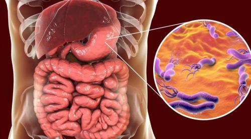 Simptomele infecției cu Helicobacter pylori. Se poate trăi cu această bacterie în stomac?