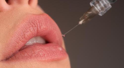 Ți ai mărit buzele? Cele 4 greșeli care pot strica rezultatul după injectarea cu acid hialuronic