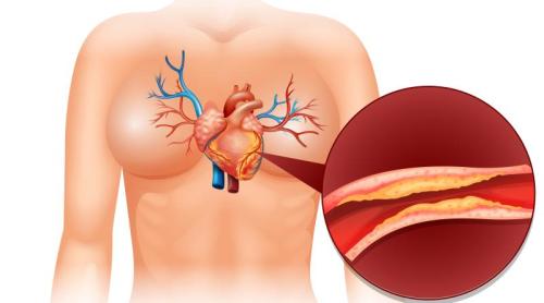 Tineri de 20 de ani, cu artere deja afectate? De ce crește riscul cardiovascular