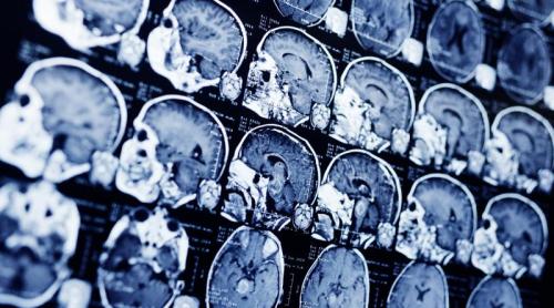 Ce au descoperit cercetătorii despre cel mai agresiv cancer cerebral