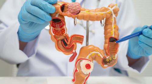 Cum reducem riscul de cancer colorectal. Recomandările unui medic gastroenterolog