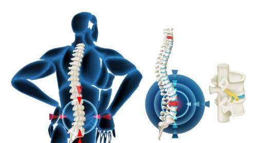 Hernia de disc nu trebuie operată întotdeauna. Când este necesară intervenția, explică neurochirurgul Ștefan Suditu