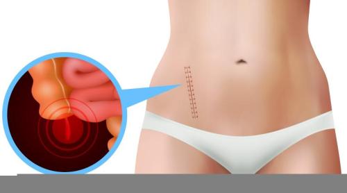 Operația de apendicită este asociată cu un risc de cancer colorectal cu 58% mai mic decât tratamentul