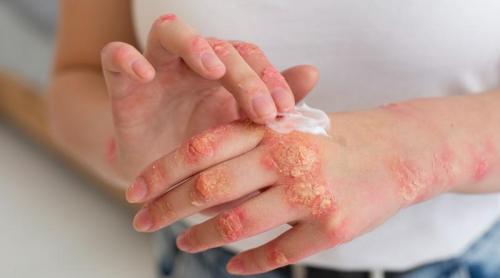 Psoriazisul cu pustule nu afectează doar pielea: risc mai mare de boli grave și mortalitate