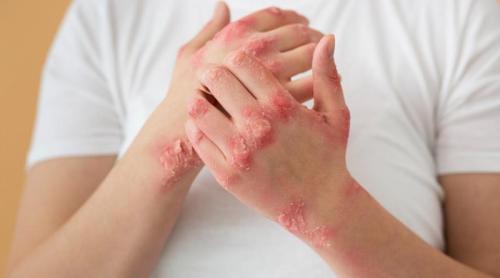 Psoriazisul, mai complicat decât pare. Ce s a descoperit în urma noilor cercetări