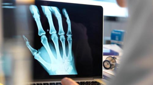 Tratament experimental pentru osteoporoză testat pentru prima dată pe oameni