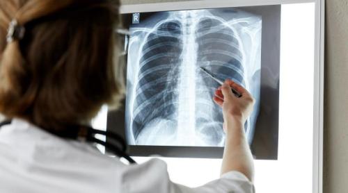 Cancer pulmonar la nefumători: factori de risc și simptome