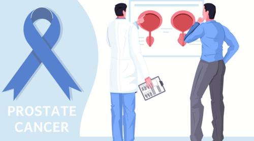 Cancerul de prostată agresiv: un medicament adăugat la tratamentul standard a redus riscul de răspândire a bolii