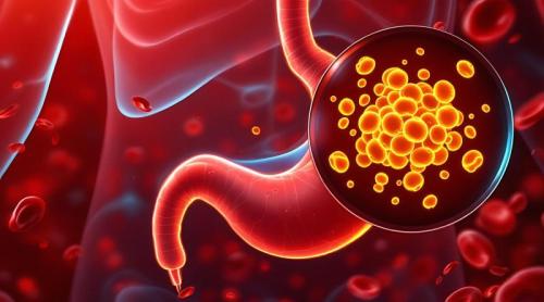 Cancerul gastric poate începe cu simptome banale. Avertismentul unui medic despre semnele care nu trebuie ignorate