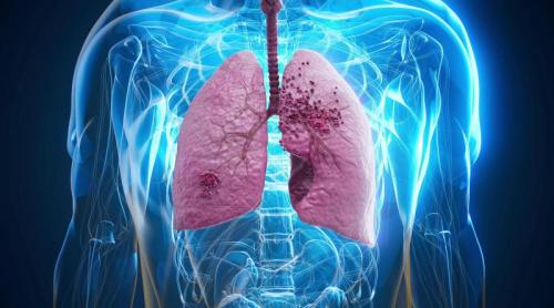 Ce este mai exact un nodul pulmonar și care este legătura cu cancerul? Cazul Papei Leon