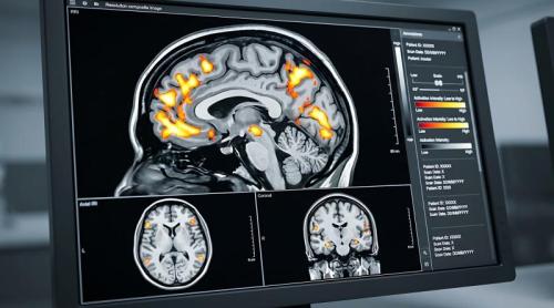 Metastazele cerebrale, una dintre cele mai grave complicații ale cancerului de sân