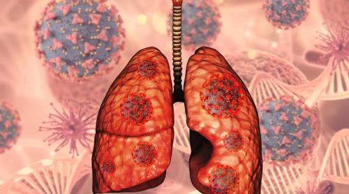 Nodulii pulmonari: când pot indica un cancer pulmonar și cine are nevoie de investigații. Conf. univ. dr. Beatrice Mahler explică