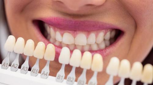 Pot avea fațete dentare fără șlefuirea dinților? Un stomatolog explică în ce cazuri este posibil