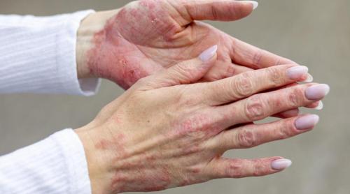 Psoriazisul ar putea fi combătut cu un supliment alimentar obișnuit