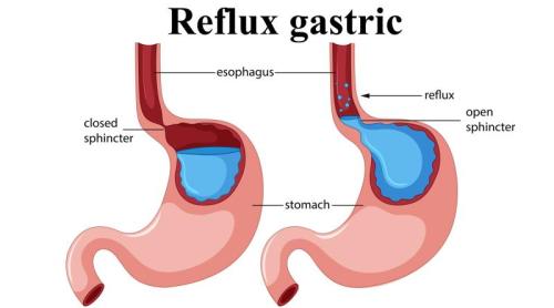 Remediul cu oțet care ar putea ajuta în refluxul gastric. Atenție însă, uneori poate agrava simptomele
