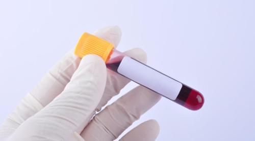 Testul de sânge care ar putea depista Alzheimer înaintea simptomelor. Prof. Peter Jenner: Cea mai bună variantă